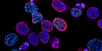 Human colorectal cancer cells treated with a topoisomerase inhibitor and an inhibitor of the protein kinase ATR (ataxia telangiectasia and Rad3 related), a drug combination under study as a cancer therapy. Cell nuclei are stained blue; the chromosomal protein histone gamma-H2AX marks DNA damage in red and foci of DNA replication in green. Created by Yves Pommier, Rozenn Josse, 2014