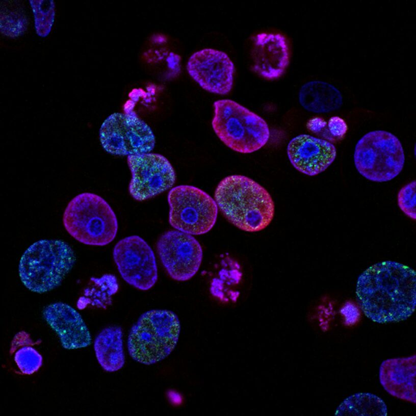 Human colorectal cancer cells treated with a topoisomerase inhibitor and an inhibitor of the protein kinase ATR (ataxia telangiectasia and Rad3 related), a drug combination under study as a cancer therapy. Cell nuclei are stained blue; the chromosomal protein histone gamma-H2AX marks DNA damage in red and foci of DNA replication in green. Created by Yves Pommier, Rozenn Josse, 2014